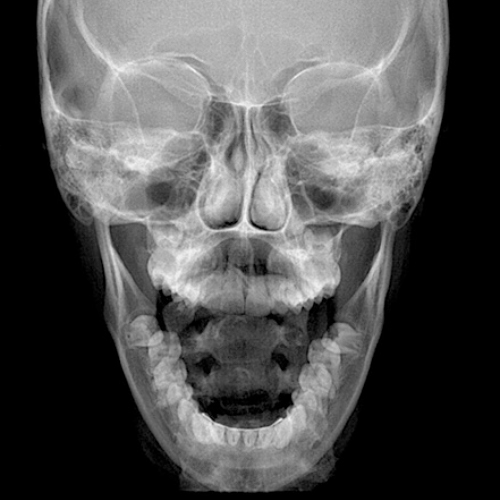 P.A. de Mandíbula - Unimagem Radiografia Odontológica Curitiba