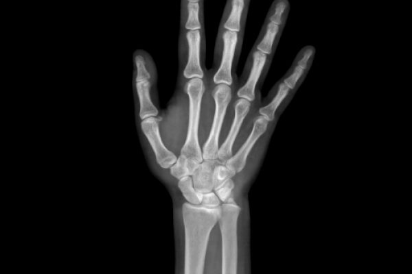Unimagem-RADIOGRAFIAS-DE-IDADE-OSSEA