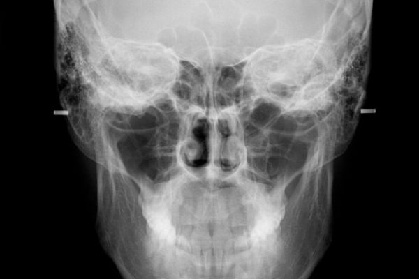 frontal
