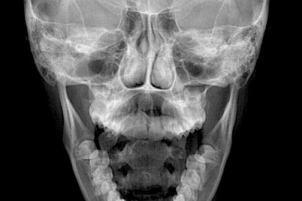 mandibula